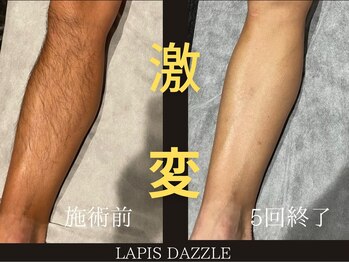 ラピスダズル(LAPIS DAZZLE)/ひざ下脱毛☆途中経過