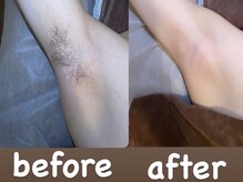 ソーレエルーナ(SOLE e LUNA)/ワキ光脱毛 ワキワックス脱毛