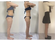 プリマルーチェ/脂肪冷却