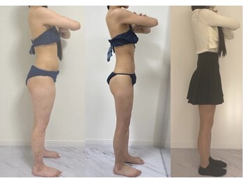 プリマルーチェ/脂肪冷却