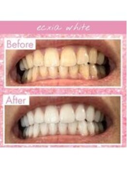 エクシアホワイトニング 長崎店/ホワイトニングビフォーアフター