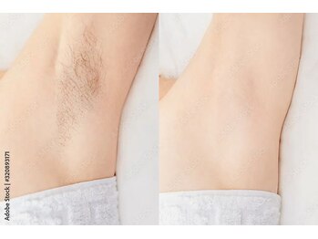 クレサロ リペル/ワキ脱毛のみもやっております