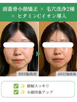 ブプラ 代々木上原店(BUPURA)/小顔×肌質改善