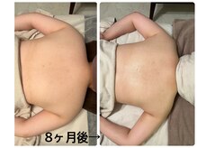 スターエステ(STAR ESTHE)/ブライダルケア(背中・二の腕)