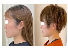 ワイサロン(Y salon)/【小顔症例】コルギ12回目