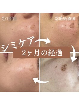 ハリーネ(HARINE)/【2回で効果実感】