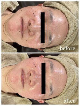 ジャスミン(Jasmin)/臍帯血幹細胞×NMN×AC-11