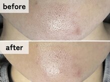 エアル(earu.)/BA|毛穴ケア|ピーリング|高円寺