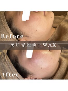 エピナ 千葉店(Epina)/フェイシャルMIX脱毛☆