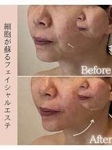 ココロ(COCORO)/3日間かけてお肌のレバルがUP！