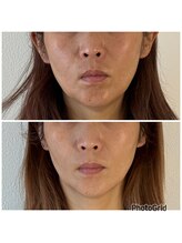 ピュアプラス(Pure Plus)/Before/After