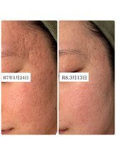 クラン 森ノ宮店(Clan)/深いニキビアとでもこんなに変化