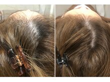 セントラル鍼灸院リラクシー(Re:laxy)/20代でも頭皮を酷使したら