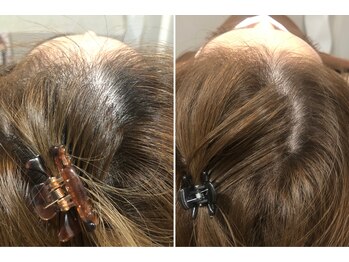 セントラル鍼灸院リラクシー(Re:laxy)/20代でも頭皮を酷使したら