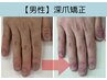 【再発させない深爪矯正】男性ハンド