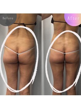 レチカ(Rechica)/キャビテーション＋深部ラジオ波