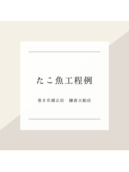 巻き爪補正店 鎌倉大船店/～タコ・魚の目工程例～