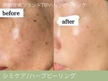 オーエン 小倉店(o-eN)/シミケア/ハーブピーリング