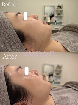 ルノン(Lunon)/毛穴洗浄ハイドロ×ララピール