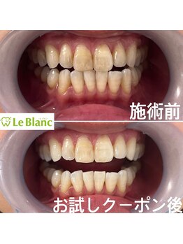 ルブラン 奈良店(Le Blanc)/15分2回で抜群の効果でます！