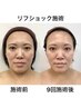 【小顔リフショック】衝撃波★で癒着にアプローチ!驚きのリフト力◎