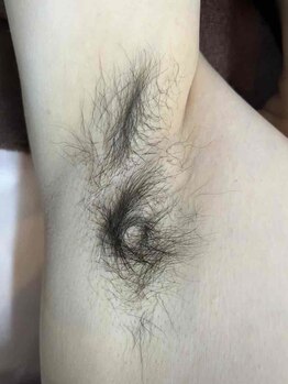 エルミューノ(elμno)/ワキ脱毛 ビフォー