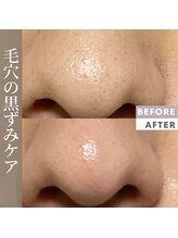 ロール(Rowl)/ハーブピーリングで毛穴ケアまで