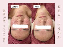 ルア(LuA.)/リベルハーブピーリング◎