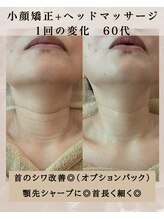 ビュート/小顔矯正　１回