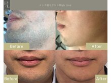 ハイリンク(High Link)の雰囲気（《だんだん濃くなるヒゲに》早めの脱毛、モテる男へ(メンズ脱毛)）