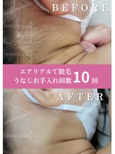 エアリアル 中津店/うなじ脱毛10回後のお客様