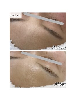 ルシアル(Rucial)/白玉ワックス◇Before／After