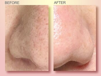 ジュリア オージェ 梅田店/ビフォーアフター（鼻スパ）