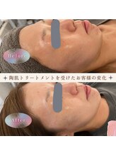 ブルームーン(Blue Moon)/REVI　1回施術