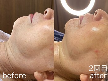 ハレオラ(HaleOla)/70代 素肌を育てる1stSTEP2回目