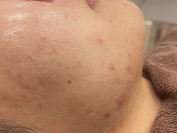 ルナート(Lunart)/ハーブピーリング【お顔】