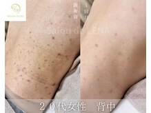 サロンドレナ 名駅店/ハーブピーリング サロンドレナ