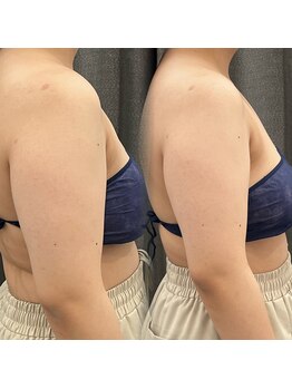 アエ メゾン(ae maison)/上半身も二の腕もスッキリ