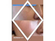 ヴィーナス(Venus)/ダイヤモンドピール/ピーリング