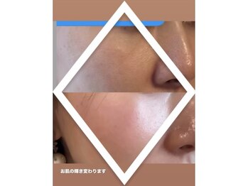 ヴィーナス(Venus)/ダイヤモンドピール/ピーリング