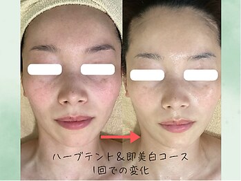 こもれび/１回のお手入れでの変化