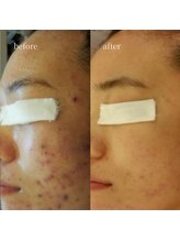 アーネスト 大阪心斎橋店(EARNEST)/韓国式光美容【 痒み・殺菌 】