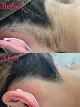 ミース 越谷店/うなじ矯正●Before、After