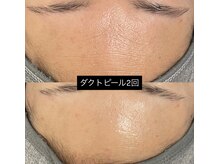 ソアン(Soin)/ダクトピール2回