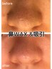 【小鼻黒ずみケア】人気オプション！小鼻wax脱毛&吸引15分