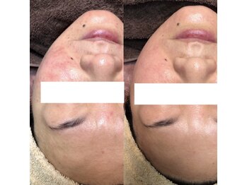 ビーダブリュー(BW...)/Eライト（光＋高周波)赤ら顔改善