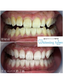 ホワイトニングサロン 熊本店/新市街ホワイトニング