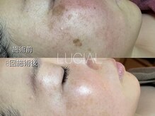 ルシアル(LUCIAL)