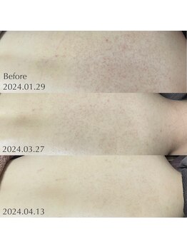 ラ ジェム(la gemme)/背中や二の腕の肌トラブル