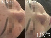 ベル 川越(Belle)/ハーブピーリング｜ニキビケア